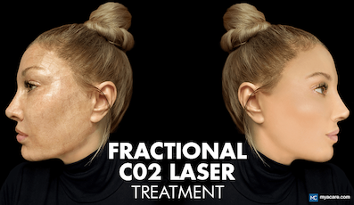 FRACTIONAL CO2 LASER: A GUIDE TO SKIN RESURFACING AND RENEWAL
